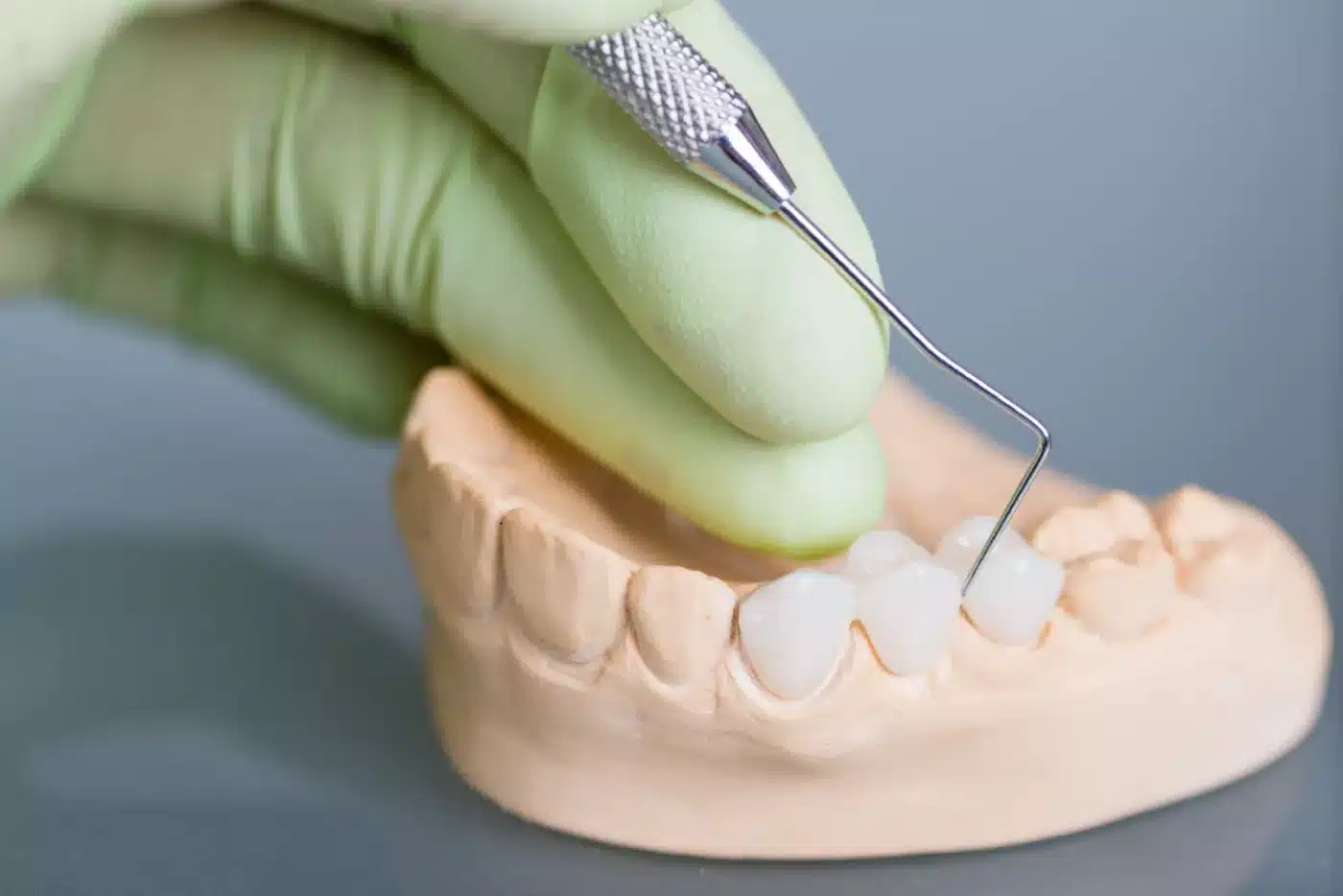 Dental bridges procedure