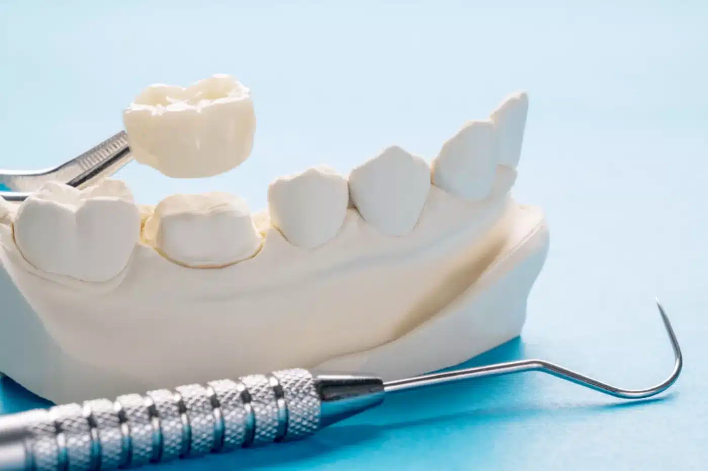 Dental crowns procedure algodones