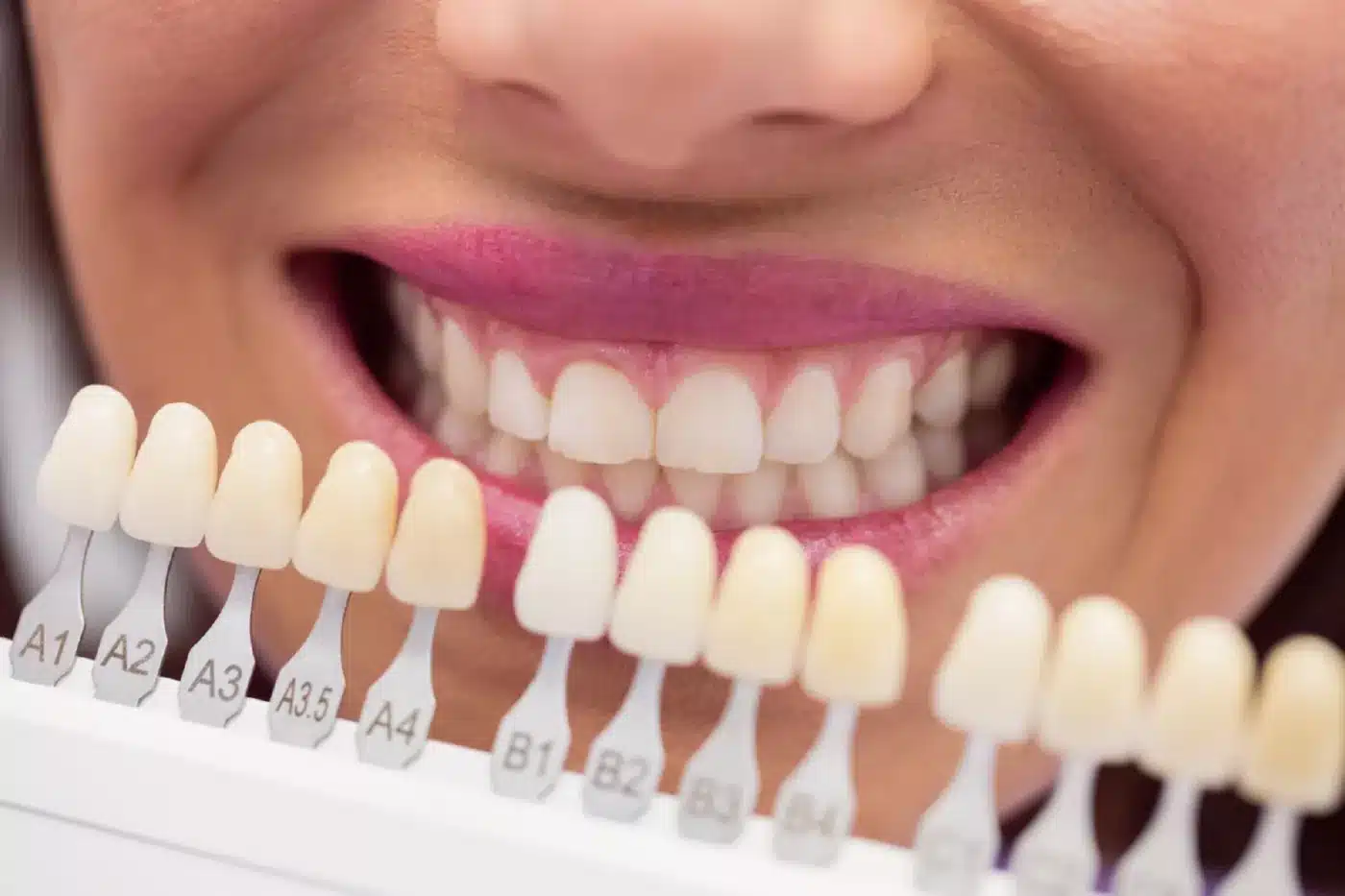 Teeth whitening scale