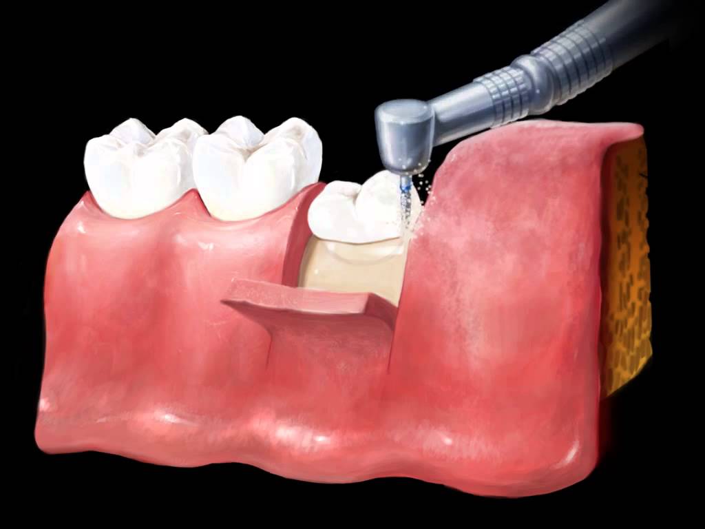 EXTRACTION PROCEDURES DentaldelrioAlgodones