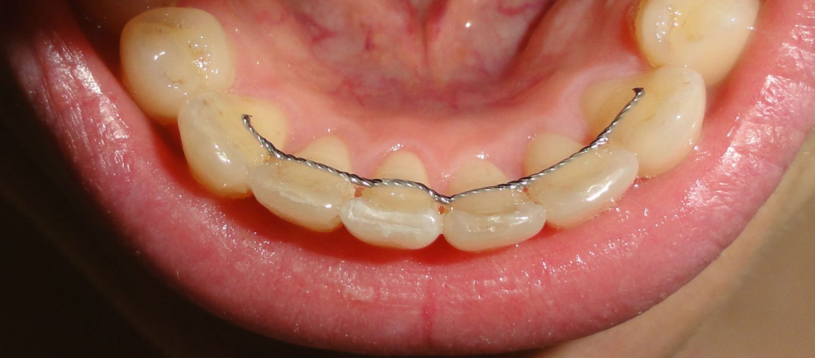 Fixed Orthodontic Retainer