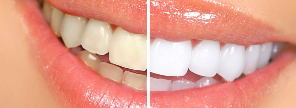 Prevent teeth stains