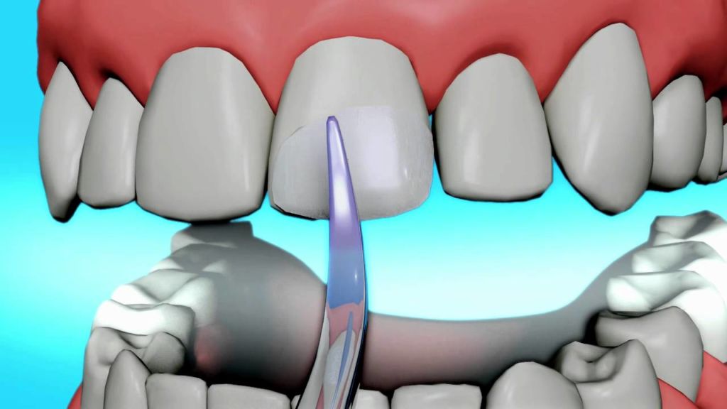 Teethbonding