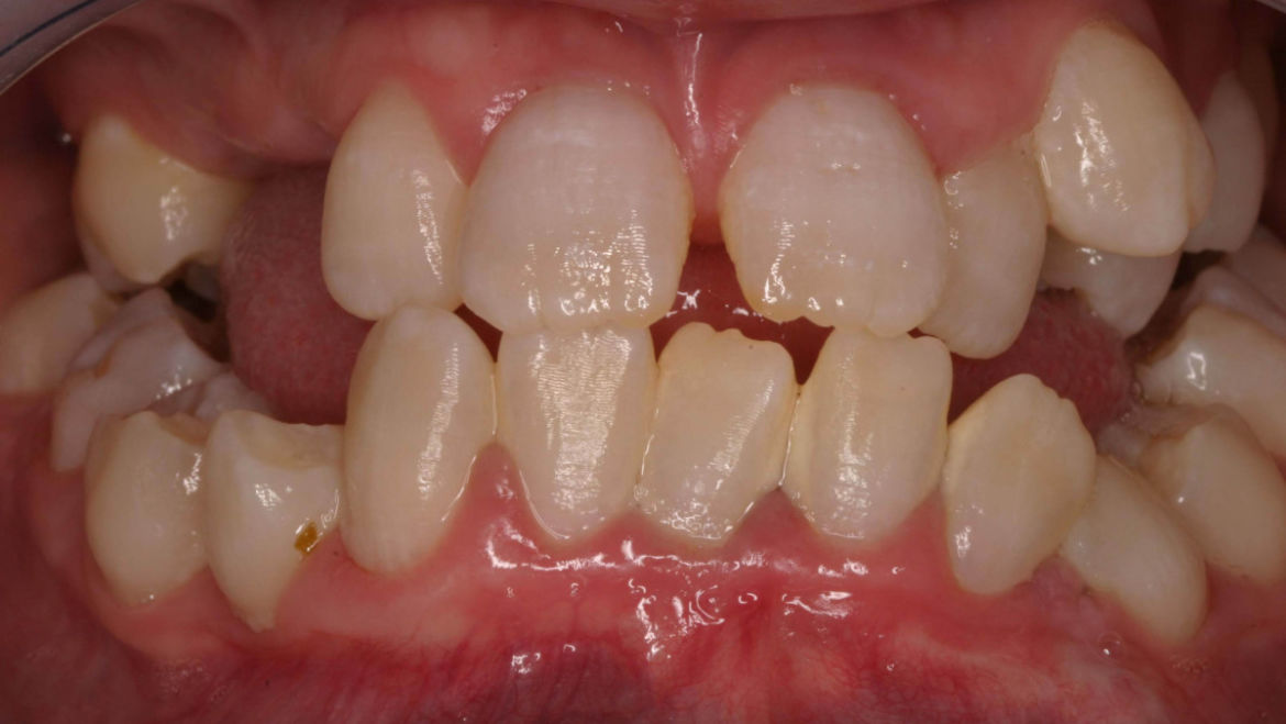 Hereditary Dentin Disorders DentaldelrioAlgodones