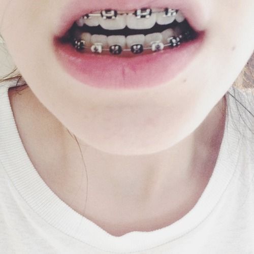 C13413fb153173eb92b754f17a84c577 cute braces black braces teeth