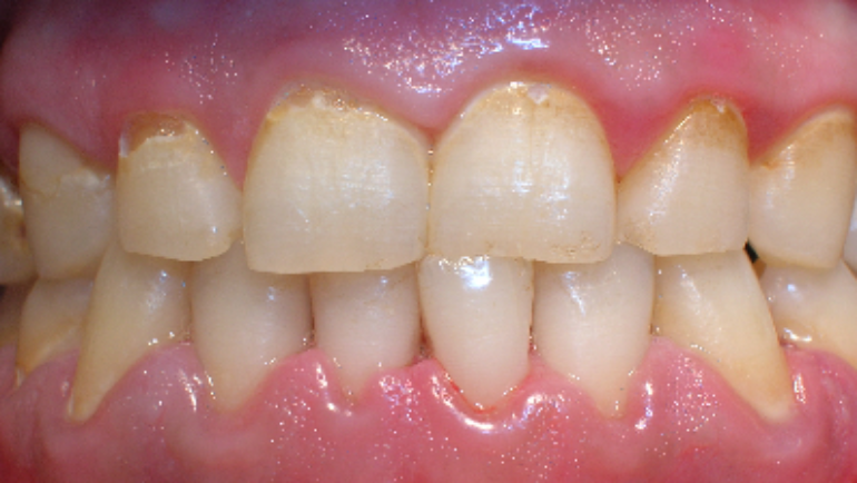 Image result for dental plaque