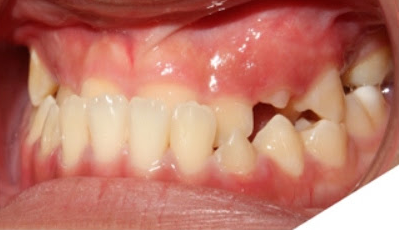 How Is A Crossbite Treated?