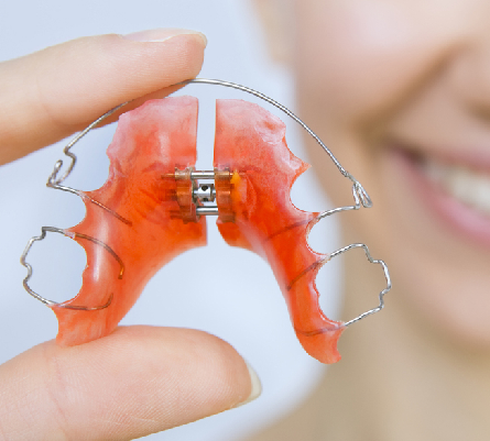 Retainers: What You Need To Know