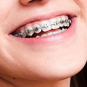 Typesofbraces