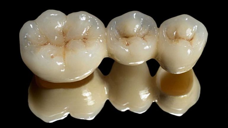 Are dental crowns worth your money?
