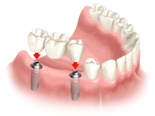 dental bridge implant page1