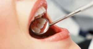 treat cavities