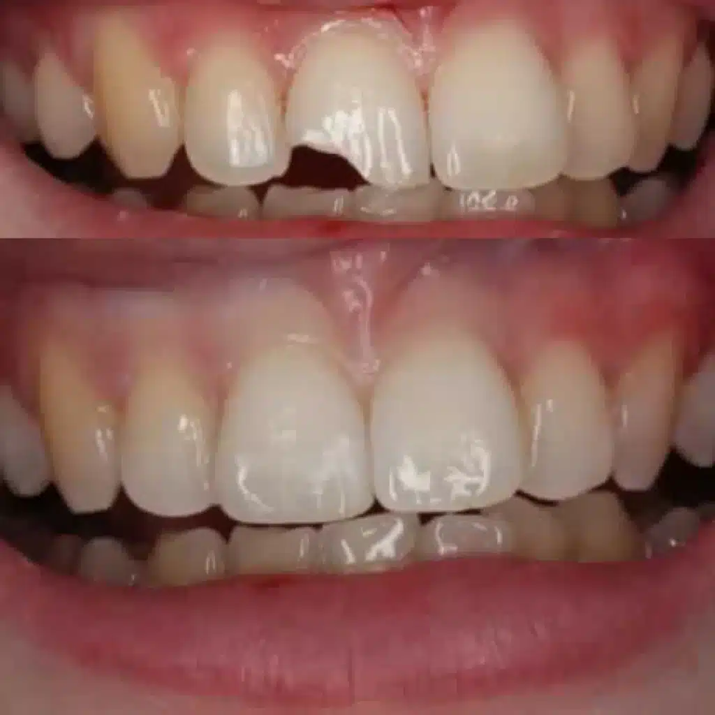 Chipped tooth before and after composite resin