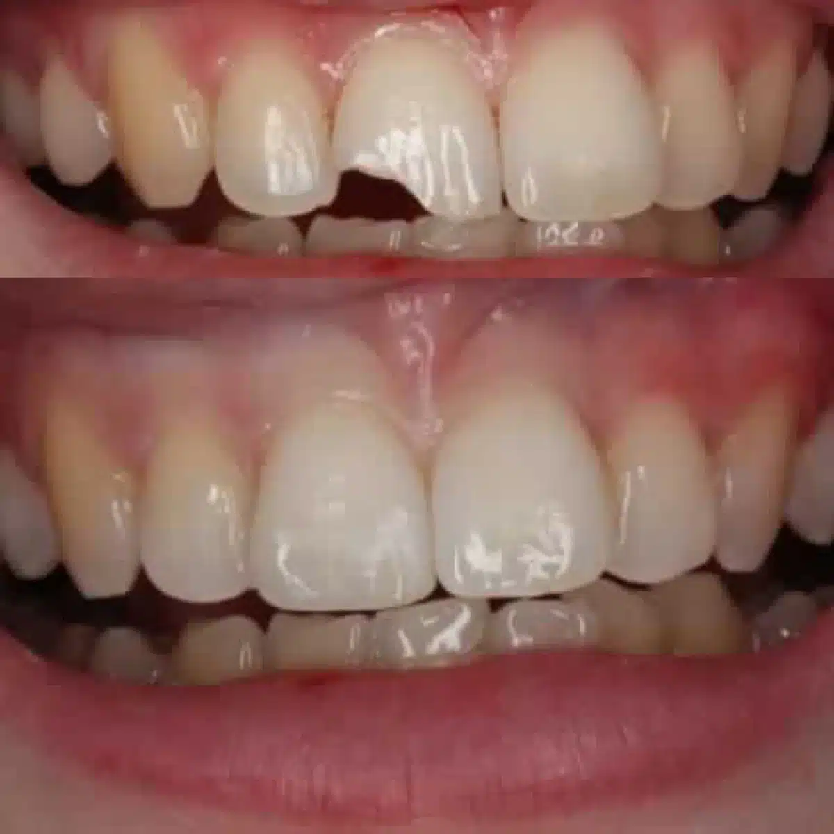 Chipped tooth before and after composite resin