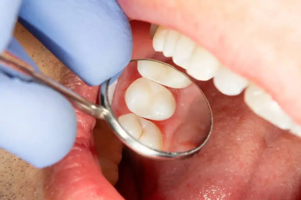 Composite dental fillings in los algodones mexico