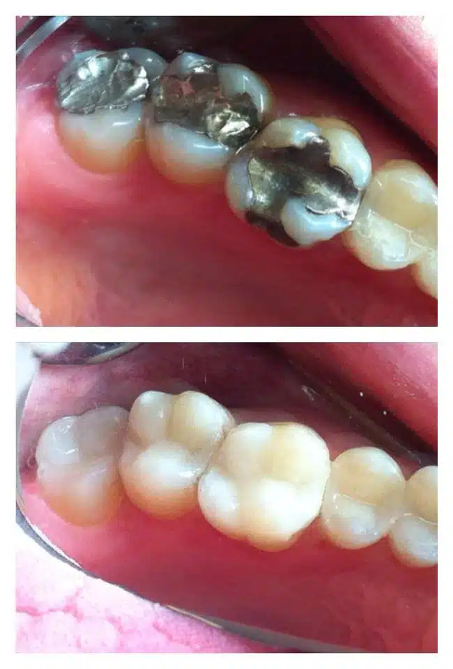 Before and after replacing amalgams with composite resin