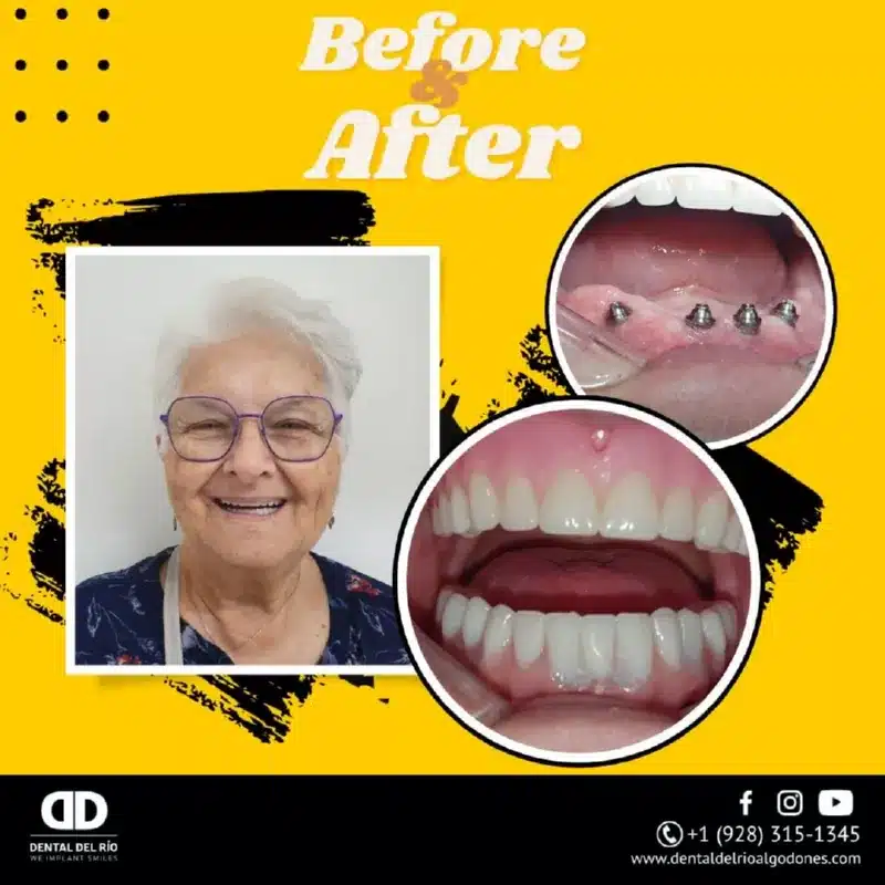 all on 4 and denture