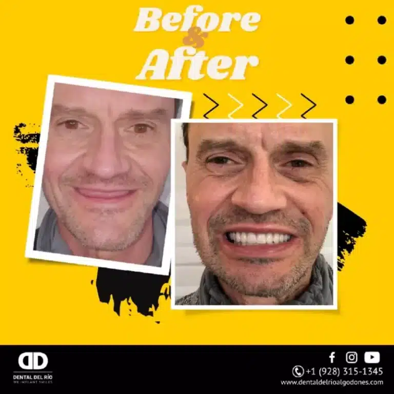 dentures