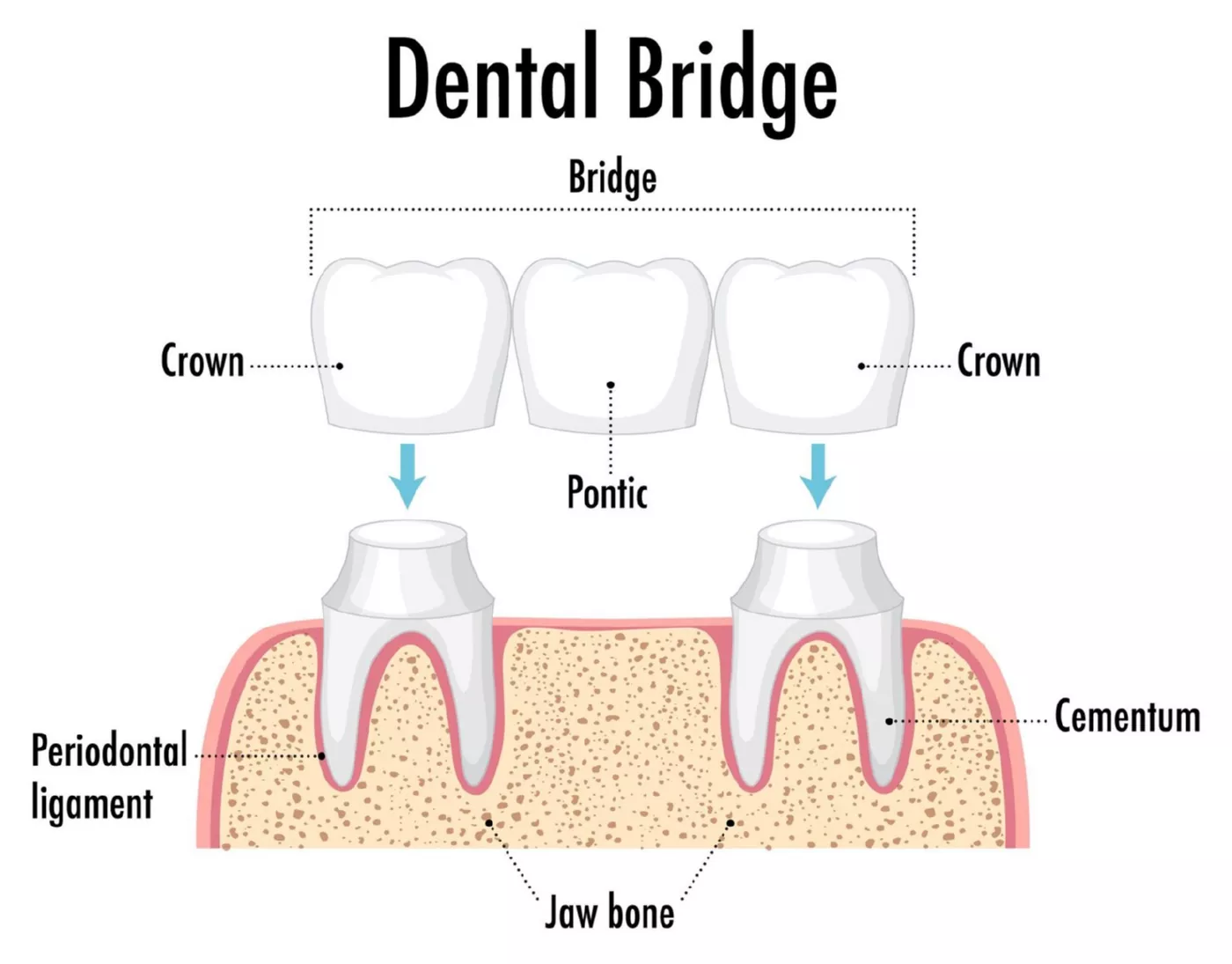Dental bridges schema