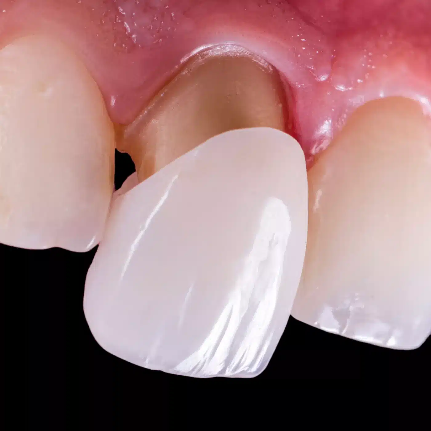 Dental crown over tooth
