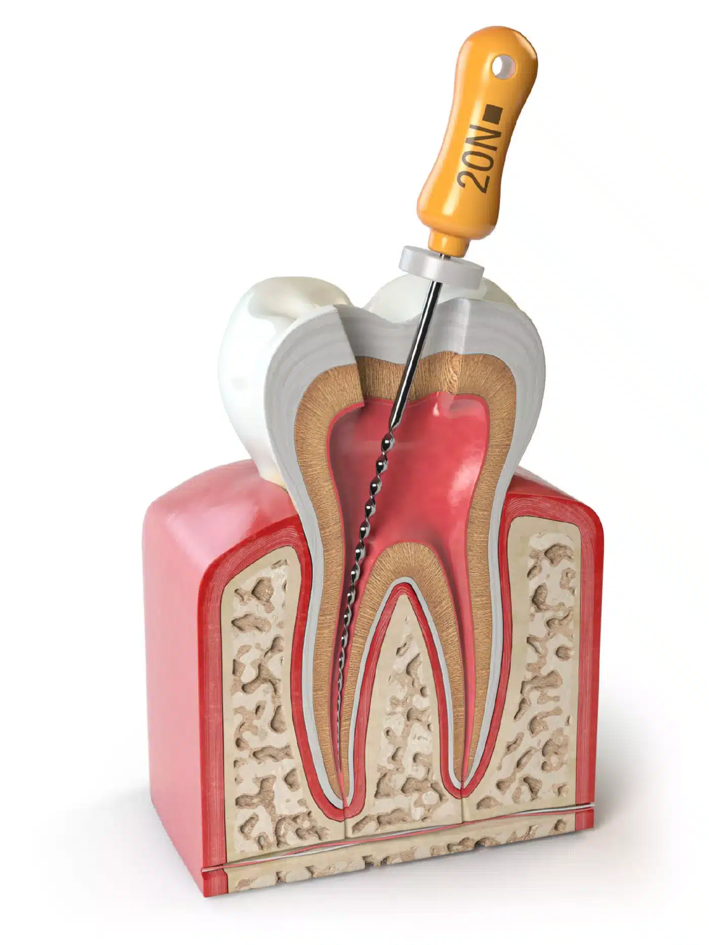 Root canal treatments in los algodones