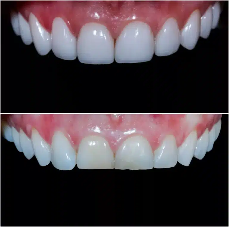 Veneers before after