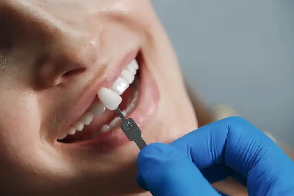 Veneers procedure