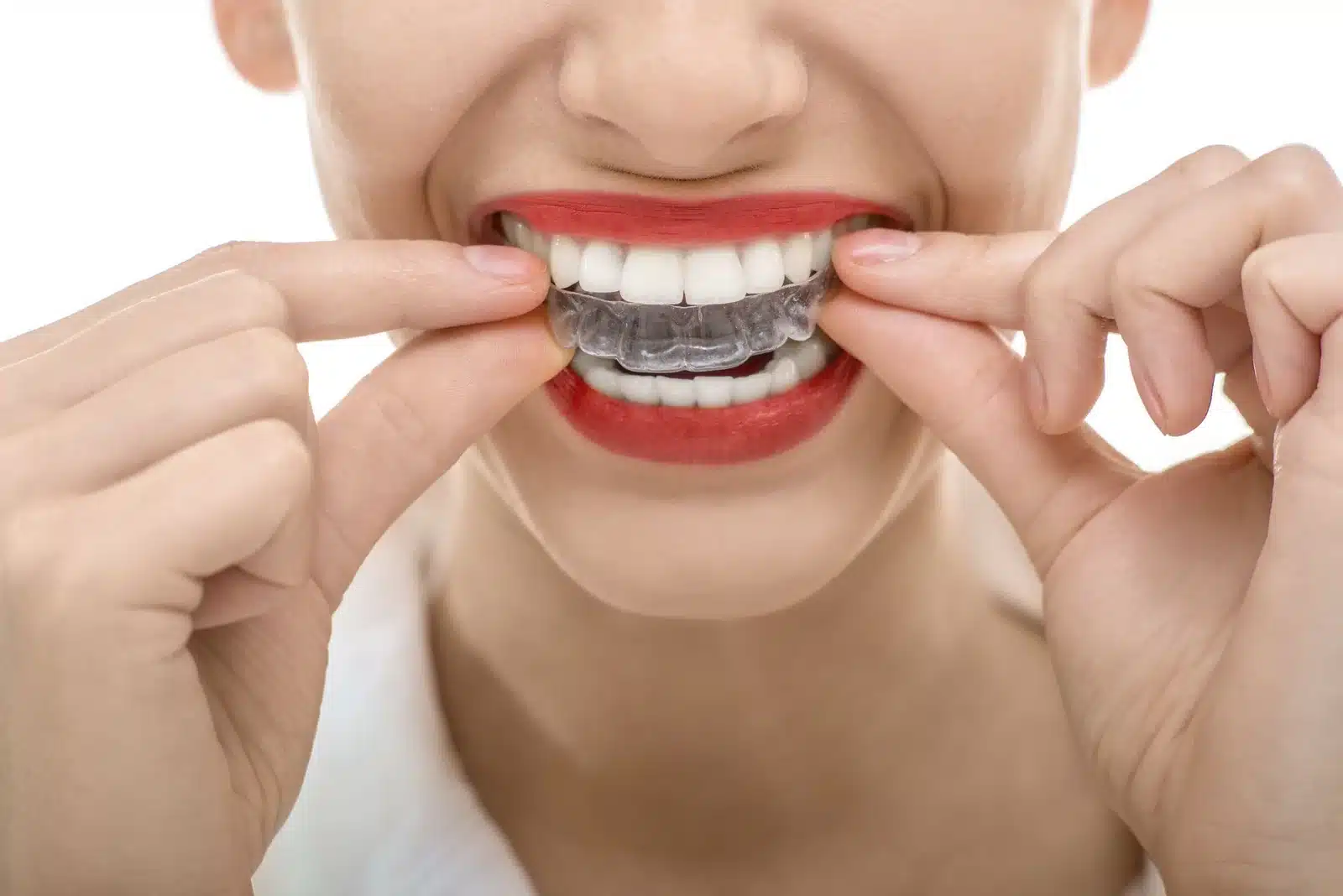 Invisalign treatment 102