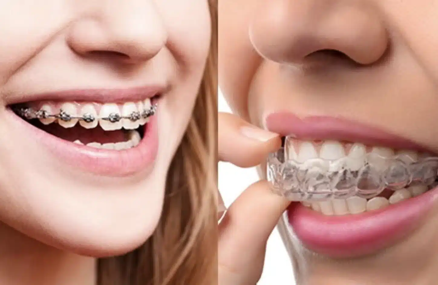 Invisalign treatment 116