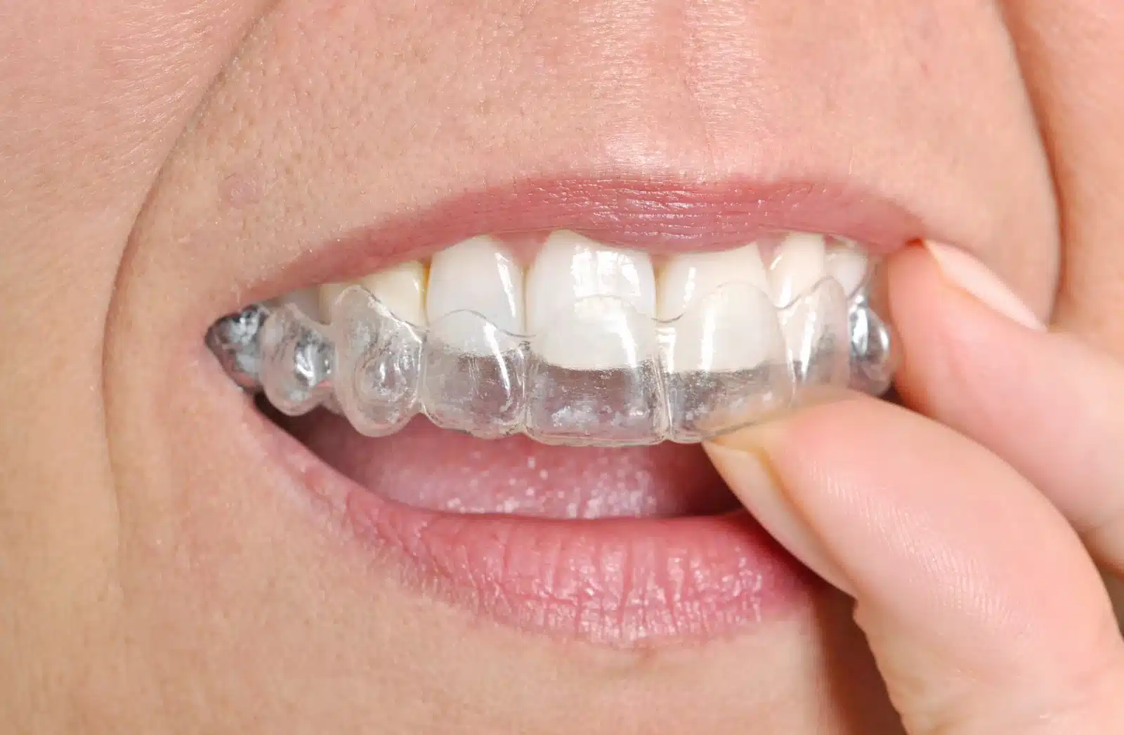 Invisalign treatment 119