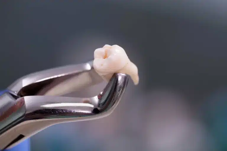 Wisdom Teeth Removal 89