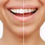 can you get veneers with missing teeth