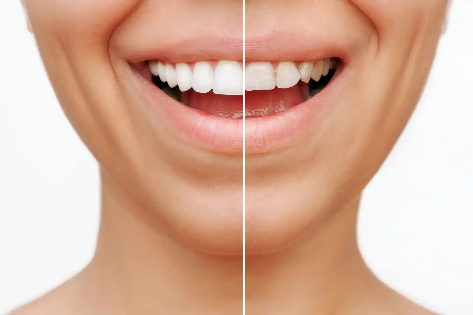 can you get veneers with missing teeth