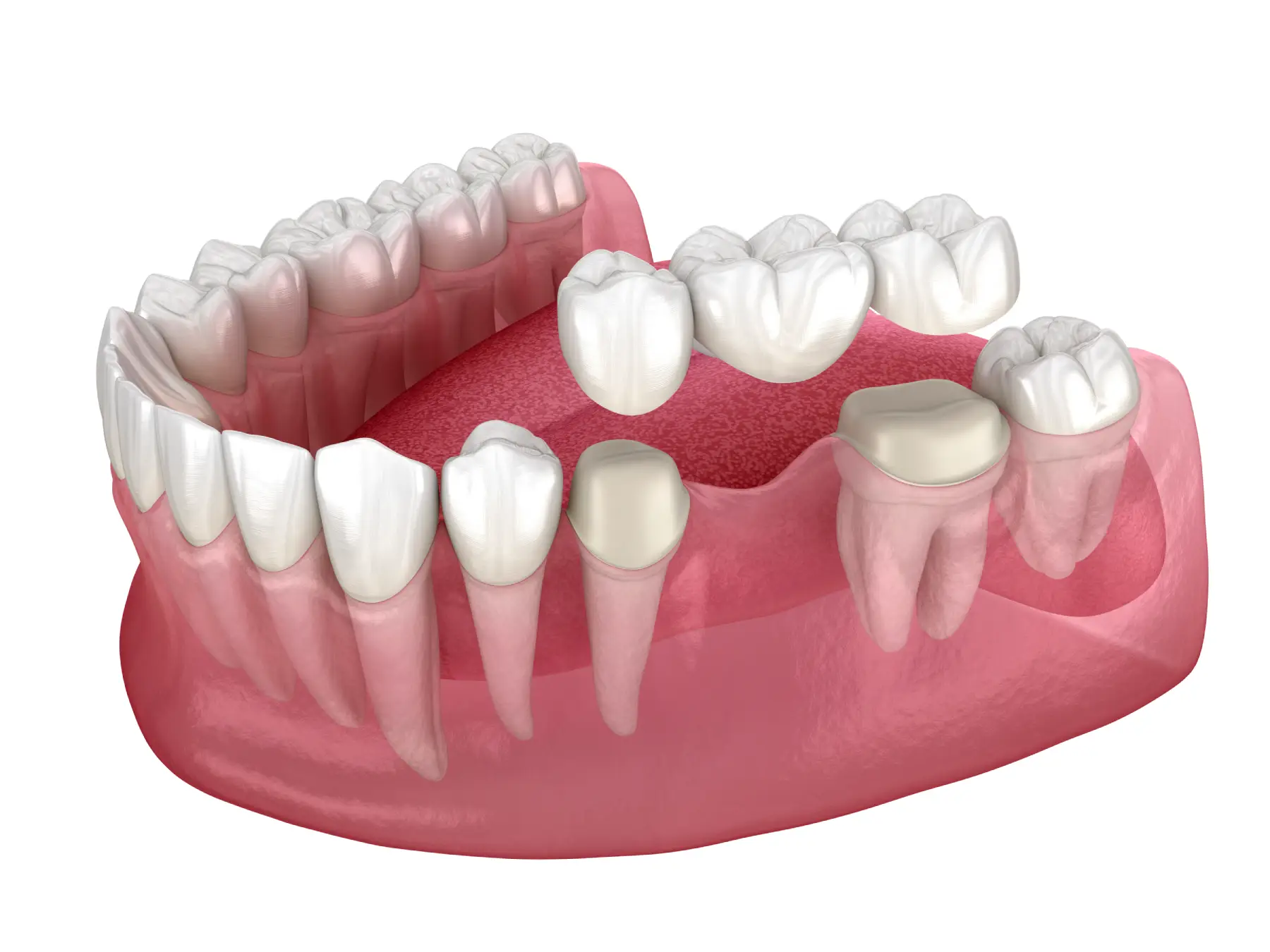 dentures vs bridges