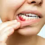 How to prevent bleeding gums