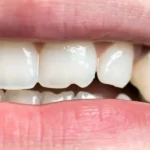 Sharp tooth