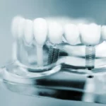 Bad taste coming from dental implant