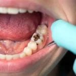 How do i get cavities even though i brush
