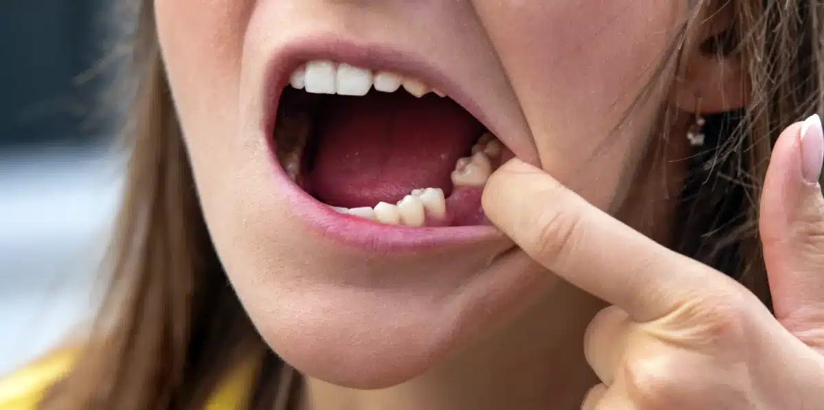 Landmark bone loss in jaw wide